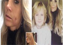 ច្រណែនកូនប្រុសកើតមកមានថ្ពាល់ខួច ស្ត្រីជាម្តាយចំណាយអស់ជិត ២ពាន់ដុល្លារ ឲ្យពេទ្យជំនាញធ្វើឲ្យដូច